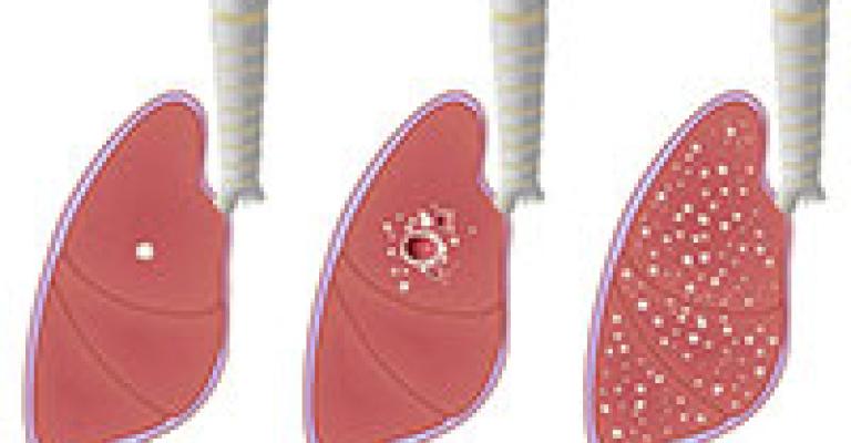 اصابات بمرض السل تعبر الحدود الى الاردن اصابات بمرض السل تعبر الحدود الى الاردن