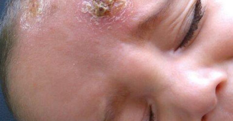 "حبة حلب" تبحث عن العلاج في الأردن "حبة حلب" تبحث عن العلاج في الأردن