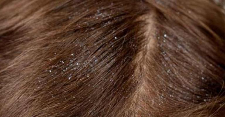 التقمل والأمراض الجلدية أكثر الأمراض إنتشارا في المدارس