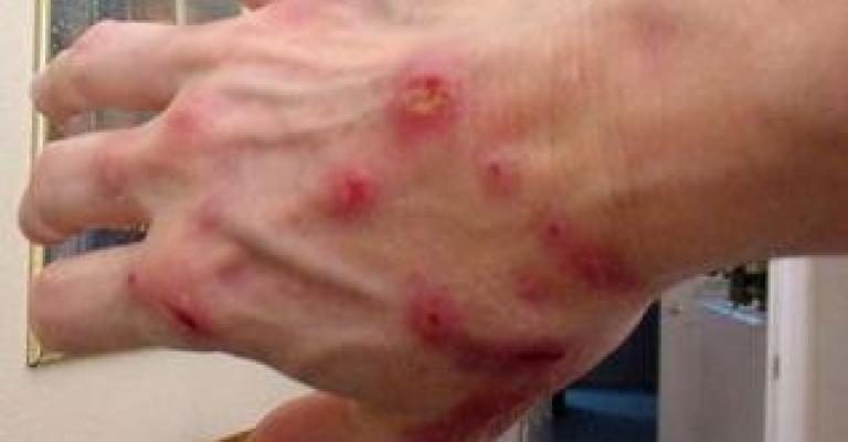 الصحة تتابع 226 حالة جرب بحكما الصحة تتابع 226 حالة جرب بحكما