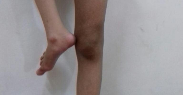 حالة صعبة لطفل أردني ولد بلا فخذ