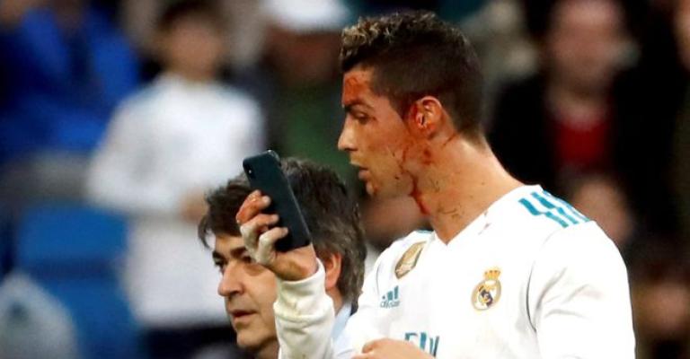 أول تمرين لرونالدو بعد إصابته بجرح في الوجه (صور)