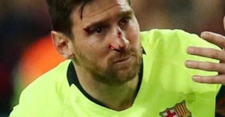 هل يشارك ميسي ضد يونايتد بعد إصابته في الوجه؟ هل يشارك ميسي ضد يونايتد بعد إصابته في الوجه؟