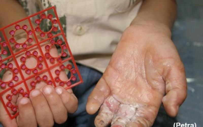 ذخيرة مسدس بلاستيكي تحرق يد طفل 