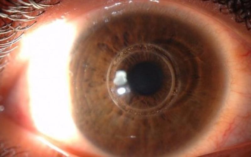 التبرع بالقرنية المخروطية يعيد لروان وروز نعمة النظر