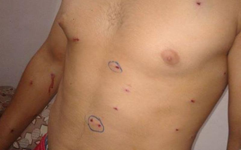 مناشدات من مخيم غزّة لوقف اعتقال المصابين والغاز المسيل للدموع