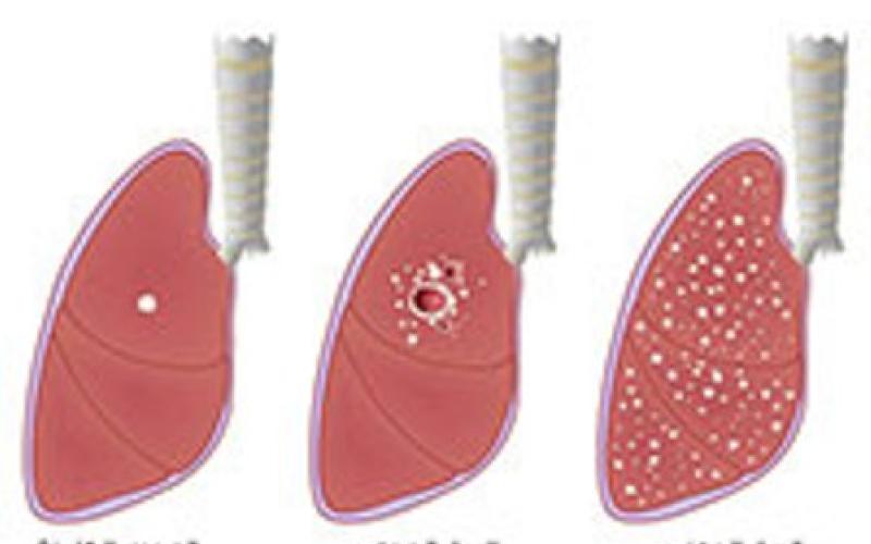 20 إصابة ب"السل" لكل 100 ألف من اللاجئين السوريين 