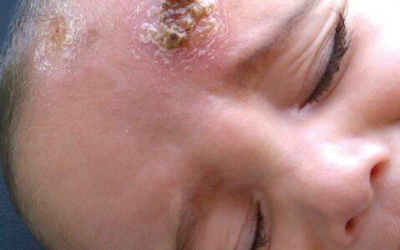 "حبة حلب" تبحث عن العلاج في الأردن