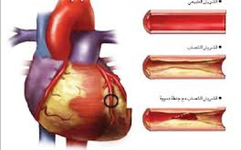 عوامل الخطر للإصابة بتصلب الشرايين