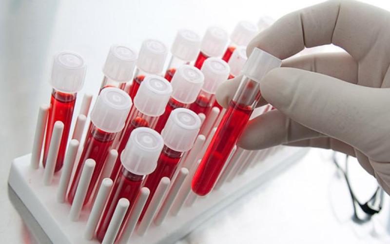 فقر الدم.. المرض الذي يصيب واحدا من كل خمسة أردنيين