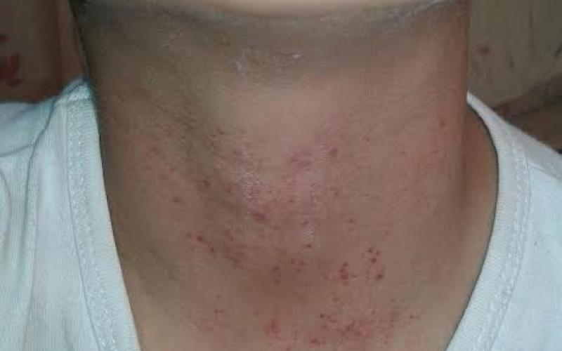 براءة وشقيقاها.. نزيف المرض واللجوء