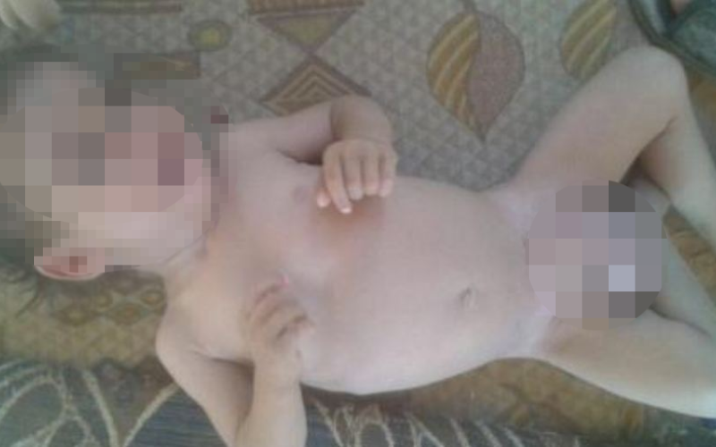 حالة طارئة لطفل في "الركبان" تحتاج جراحة عاجلة والصليب الأحمر: لا نسطيع الدخول