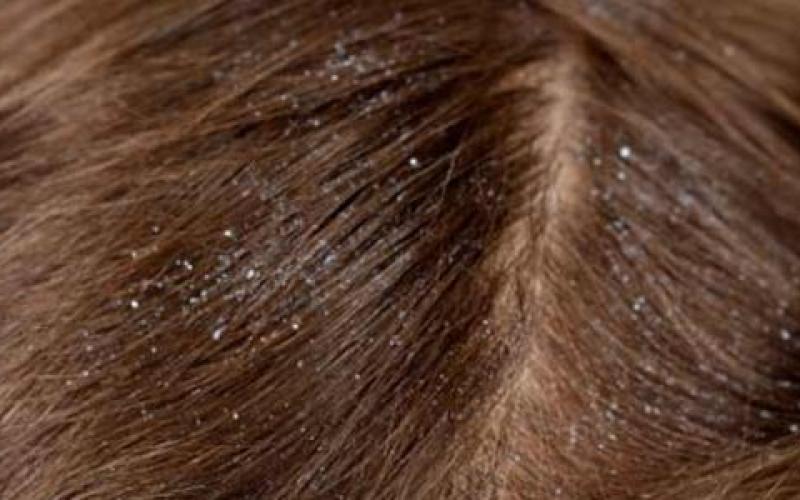 التقمل والأمراض الجلدية أكثر الأمراض إنتشارا في المدارس