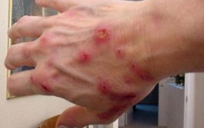 الصحة تتابع 226 حالة جرب بحكما