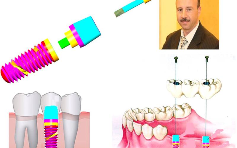 أكاديمي من "الأردنية" يسجل براءة اختراع في الغرسات السنية
