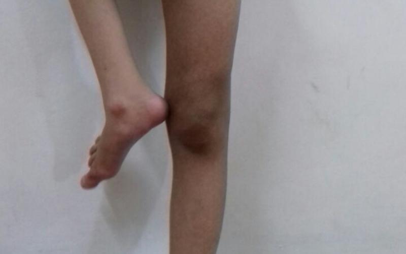 حالة صعبة لطفل أردني ولد بلا فخذ