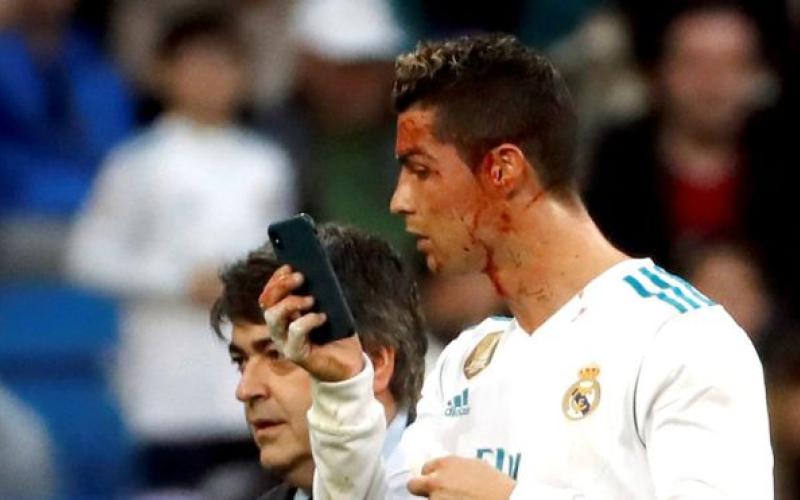 أول تمرين لرونالدو بعد إصابته بجرح في الوجه (صور)