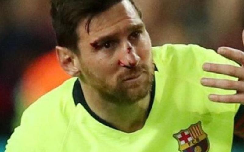 هل يشارك ميسي ضد يونايتد بعد إصابته في الوجه؟